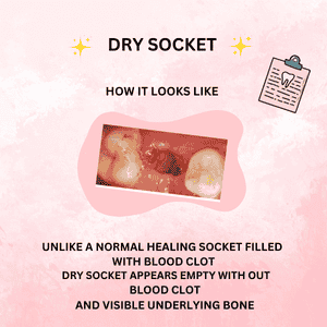 dry socket pictures
