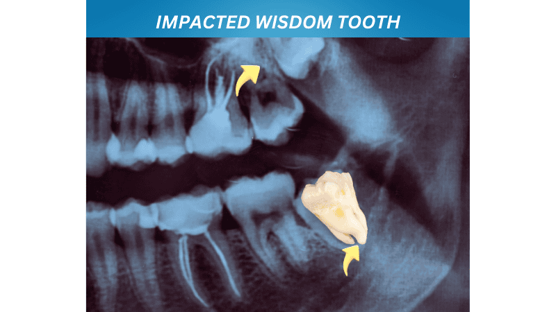 IMPACTED WISDOM TEETH